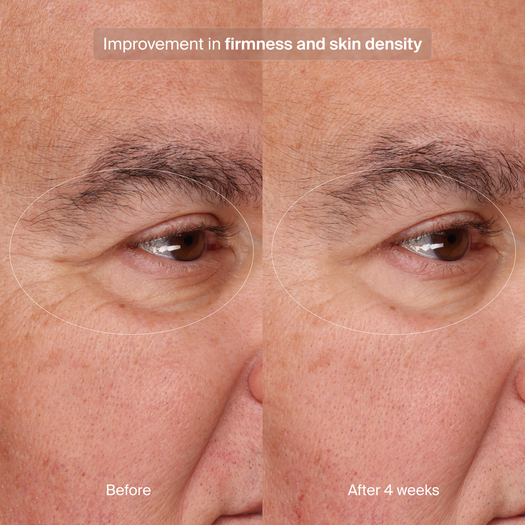 Precision Eye Lift
