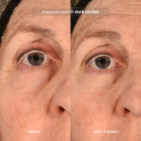 Load image into Gallery viewer, Precision Eye Lift