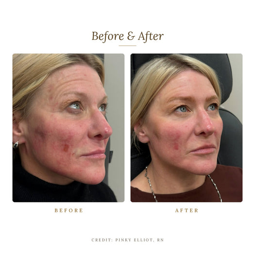 CO2Lift Pro Carboxy Gel Mask | Carboxytherapy Treatment at Home