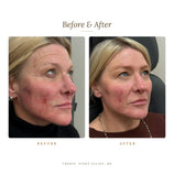 Load image into Gallery viewer, CO2Lift Pro Carboxy Gel Mask | Carboxytherapy Treatment at Home