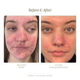 Load image into Gallery viewer, CO2Lift Pro Carboxy Gel Mask | Carboxytherapy Treatment at Home